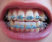 alinhamento-dentario-e-aparelhos-odontologicos-2