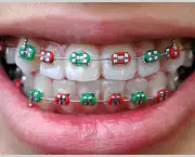 alinhamento-dentario-e-aparelhos-odontologicos-8