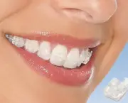 alinhamento-dentario-e-aparelhos-odontologicos-6
