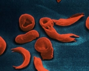 anemia-falciforme-1