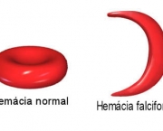 anemia-falciforme-3