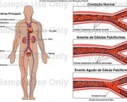 anemia-falciforme-5