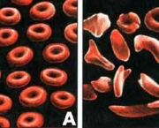 anemia-falciforme-6