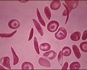 anemia-falciforme-7