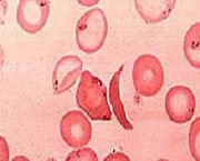 anemia-falciforme-8