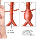 Aneurisma da Aorta Abdominal (1)