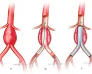 Aneurisma da Aorta Abdominal (3)