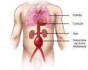 Aneurisma da Aorta Abdominal (4)