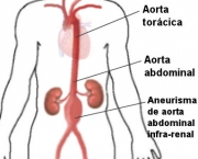 Aneurisma da Aorta Abdominal (7)