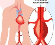Aneurisma da Aorta Abdominal (9)