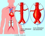 Aneurisma da Aorta Abdominal (13)