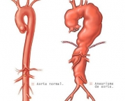 Aneurisma da Aorta Abdominal (15)