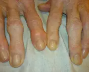 Artrite Psoriática (2)