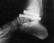 foto-artrodese-em-tornozelo-e-pe-10
