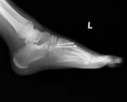 foto-artrodese-em-tornozelo-e-pe-11