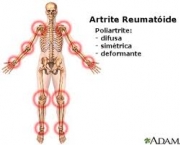 artrose-e-artrite-definicao-5