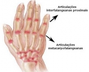 artrose-e-artrite-definicao-1