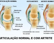 artrose-e-artrite-definicao-5