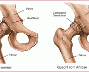 artrose-e-artrite-definicao-12