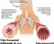 asma-infantil-principais-sintomas-e-tratamento-3