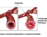 asma-infantil-principais-sintomas-e-tratamento-1