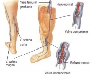 causas-do-inchaco-nas-pernas-5