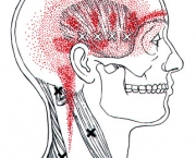 cefaleia-tensional-informacoes-sobre-o-problema-5