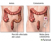 O Que e Colectomia (2).jpg