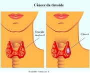 carcinoma tiroideo