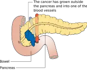 Diagram_showing_stage_T4_cancer_of_the_pancreas_CRUK_267.svg.png