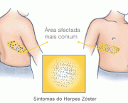 sintomas-herpes-zoster.gif