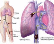 como-acontece-a-embolia-pulmonar-1