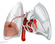 como-acontece-a-embolia-pulmonar-2