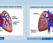 como-acontece-a-embolia-pulmonar-3