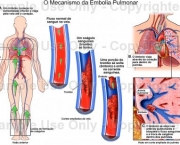 como-acontece-a-embolia-pulmonar-6