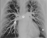 como-acontece-a-embolia-pulmonar-1