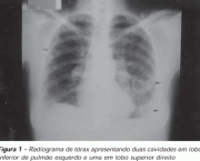 como-acontece-a-embolia-pulmonar-4