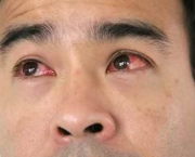 Como Tratar Coceira nos Olhos Causada por Alergias (4)