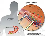 complicacoes-do-diabetes-1