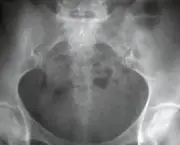 X-ray of the pelvis