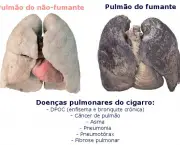 Doença Causadas Pelo Cigarro (12)