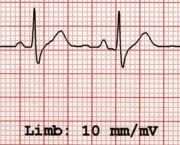 Eletrocardiograma (2)