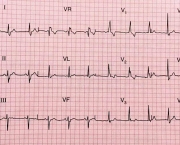 Eletrocardiograma (4)