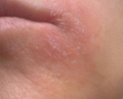 eczema-dermatose-739x311.jpg