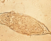 Schistosoma haematobium.Â  Egg with circumoval precipitate.