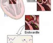 foto-endocardite-infecciosa-03