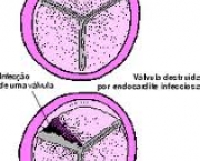 foto-endocardite-infecciosa-05
