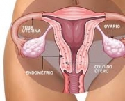 foto-endometriose-10