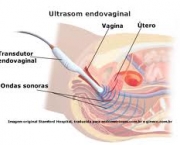 foto-endometriose-13