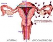 foto-endometriose-15